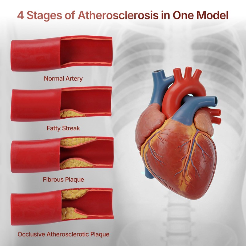 Simedutech Atherosclerosis Model, Artery Plaque Display,Vascular Disease