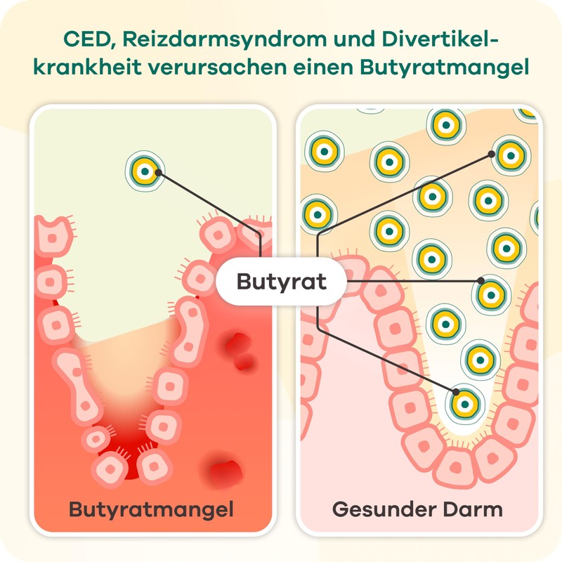 Butyzole - Diet Management for Irritable Bowel Dietra, Diverticula &