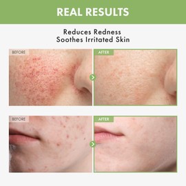 TOSOWOONG Heartleaf Face Toner with 970,200ppm Heartleaf Water, Centella, Hyaluronic Acid, Witch Hazel, Trouble Care, Acne-Prone, Calming, Hydrating, Purifying, Korean Skin Care, 250ml, 8.45 fl.oz.