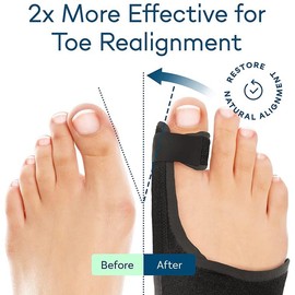 ALINO Bunion Corrector | Adjustable Toe Straightener for Men & Women | Toe Corrector Universal Fit for Left & Right Foot | Leg Finger Straightener