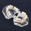 Tratamiento de Ortodoncia Dental de Maloclusión de Dientes Modelo con