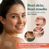 LivaClean 272 Parches para Acne Set - Pimple Patch Día