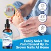 Ingrown Toenail Treatment Drops - Plant-Based Softener Solution