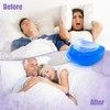 Anti Snoring Devices Effective Snoring Solution Snore Guard to Stop