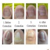 Young21 Ingrown Toenail Straightening Clip Curved Bs Brace Toenails Thick