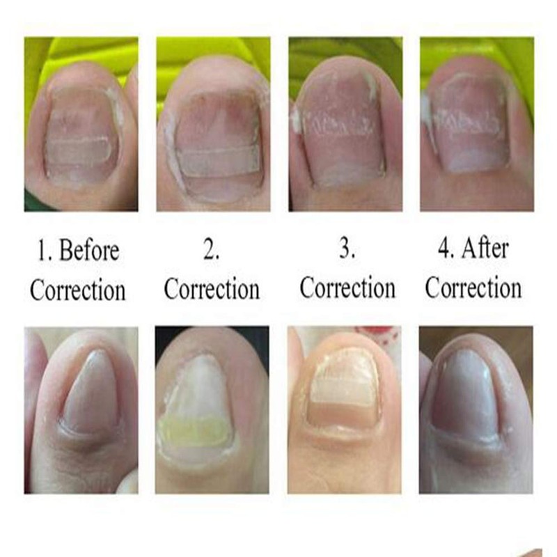 Young21 Ingrown Toenail Straightening Clip Curved Bs Brace Toenails Thick