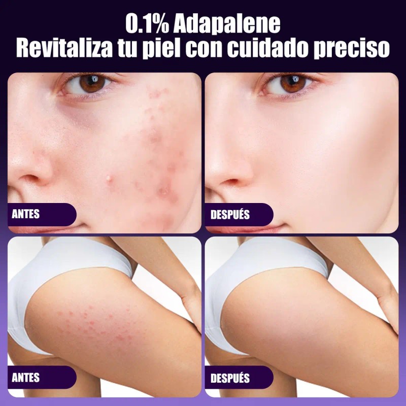 Zm T Gel Facial Antiacné Contiene Adapaleno For Piel Hy