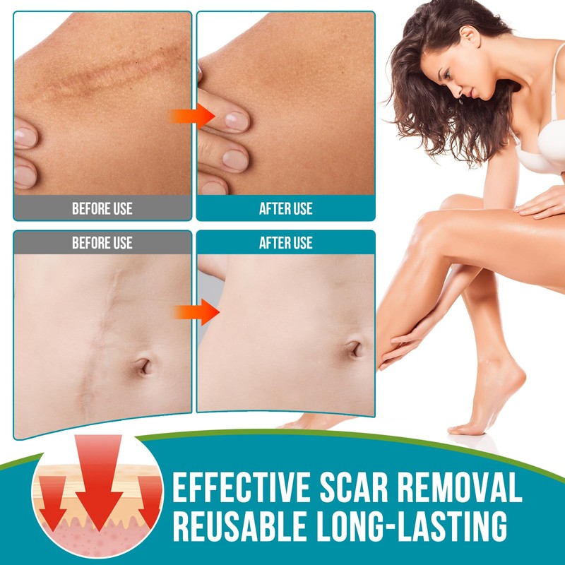 Silikonband für Narben, 300 cm, wiederverwendbar und waschbar, hautfarben