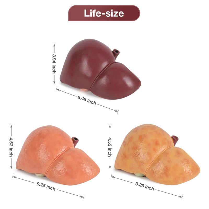 Simedutech Silicone Alcoholic Fatty Liver Model, Pathological Liver Replica for