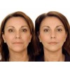 Skindulgence Estiramiento Facial Sin Cirugía 30 Min