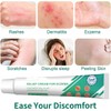 Eczema Cream Anti Itch Cream Maximum Strength