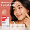 Umeva Acne Patch Hydrocolloid Pimple Patches (72 Count)