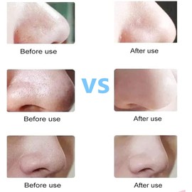 Blackhead Remover Pimple Popper Extractor – Stainless Steel Acne Removal kit – by DMX INTL