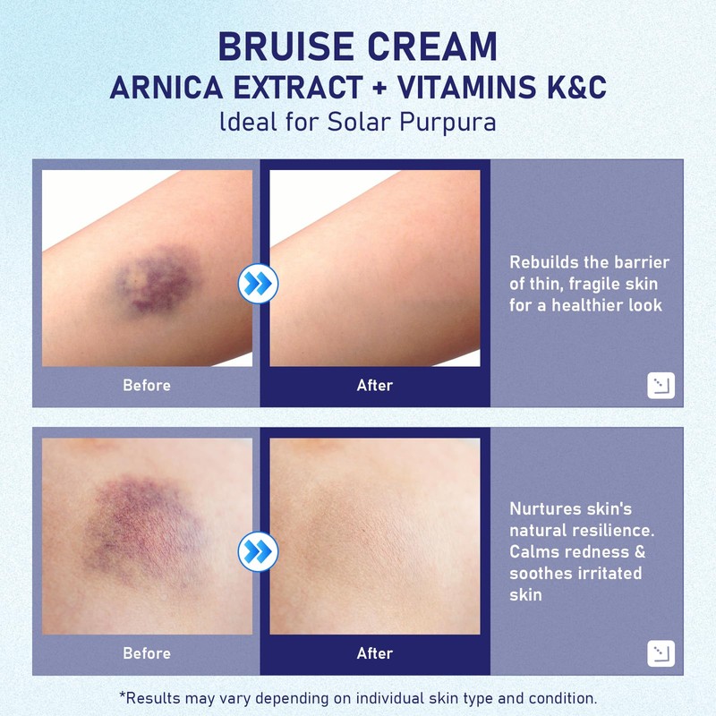 fugit Bruise Cream - Bruise Repair & Skin Arnica Bruise