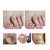 Líquido Para Hongos En Uñas - Cura Hongos Y Onicomicosis
