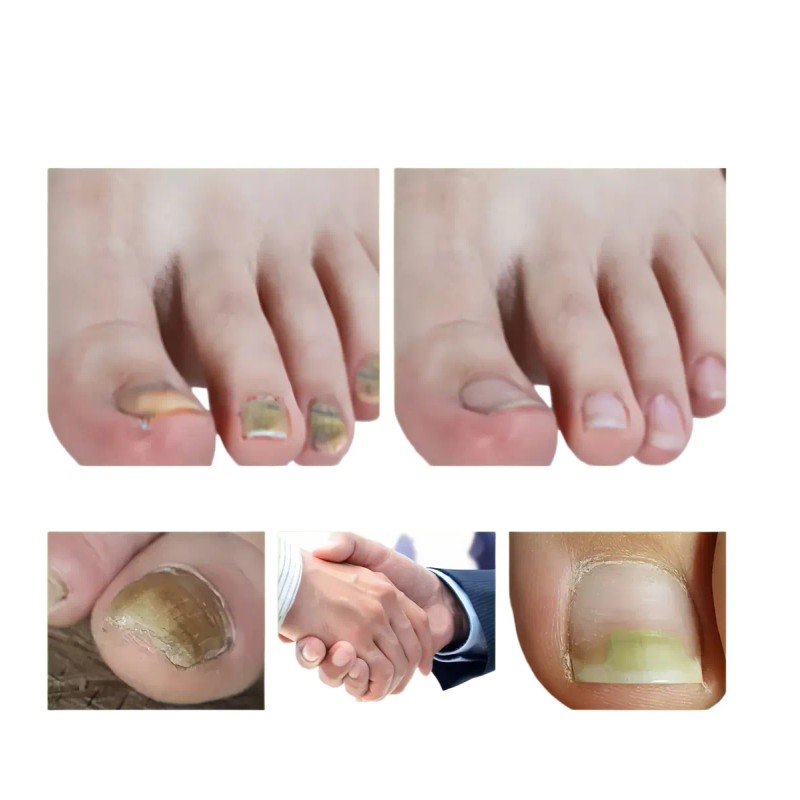 Líquido Para Hongos En Uñas - Cura Hongos Y Onicomicosis