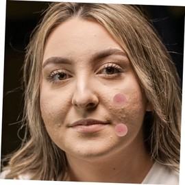 FRCOLOR Patches for Face 144 Sheets Hydrocolloid Pimple Sticker Scar Treatment Invisible Matte Design