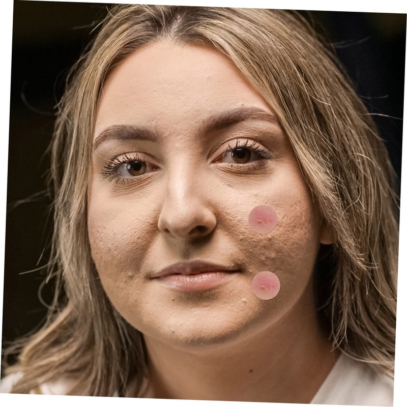 FRCOLOR Patches for Face 144 Sheets Hydrocolloid Pimple Sticker Scar