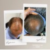Tónico Vittale Anticaída Crecimiento Restaura Cabello Paso 1