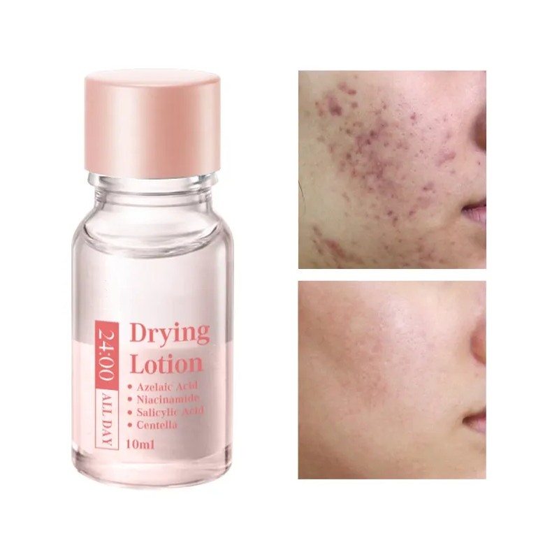Acne Buster Loción Secante Con Ácido Salicílico 2pcs Todo Tipo