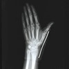 LP Support Basic Series 763 Thumb Orthosis - Thumb Brace