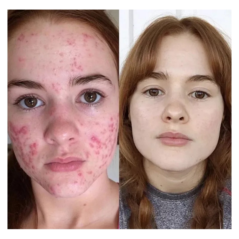 On Cream for acne, spots and wrinkles on the face.