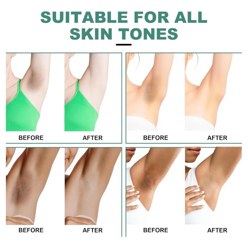 Crema Blanqueadora Para Aclarar La Piel De Las Zonas Íntimas