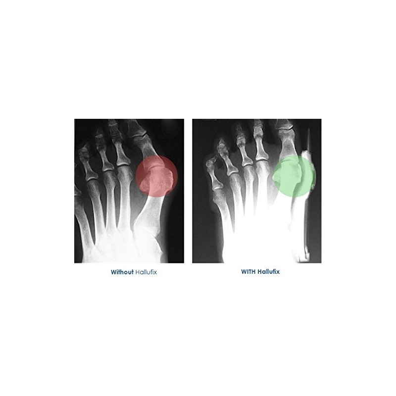 Homecraft Hallufix Bunion Aid Splint