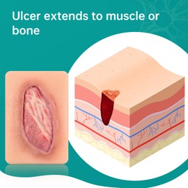 MedEduQuest Pressure Ulcer Wound Model Stage 4 Pocket Size, Wound Packing Trainer for Medical Education, Wound Care Demonstrations Tool