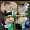 IRIAZ MOLE CREAM BUANG TAHI LALAT KUTIL BIJI KOLESTEROL