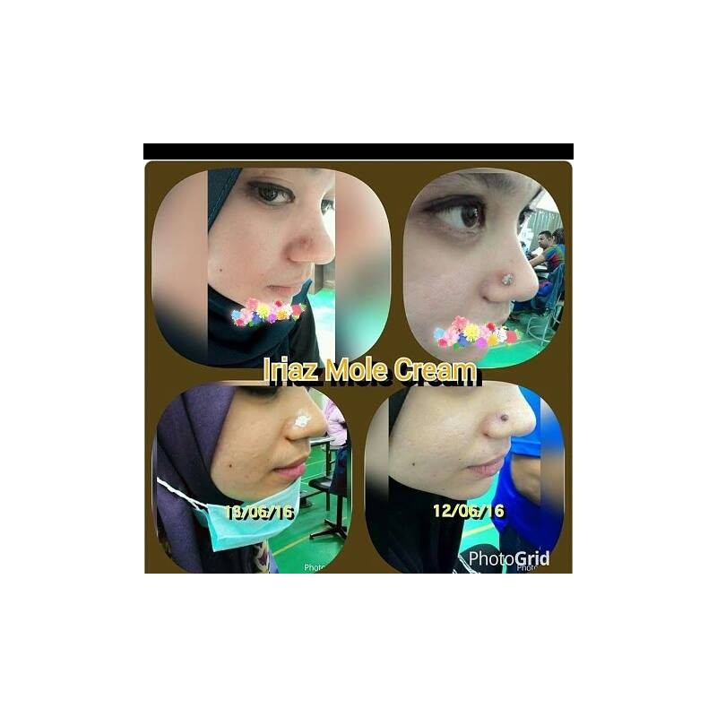 IRIAZ MOLE CREAM BUANG TAHI LALAT KUTIL BIJI KOLESTEROL