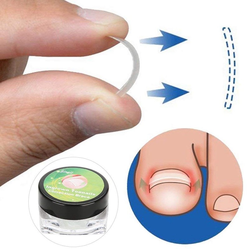 Professional Toenail Correction Paronychia Nail Sticker Correction Ingrown Pincer Toenail