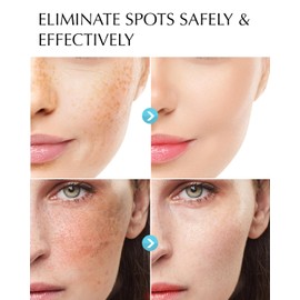 Dark Spot Remover for Face and Body: Hyperpigmentation Treatment - Natural Ingredient - Freckle/Melasma/Sun Spot/Age Spot Remover - Dark Spot Corrector Cream for Women and Men