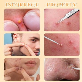 JIEYAO Set of 4 pimple tweezers, stainless steel blackhead remover set, comedone squeezer, acne, pimple remover, blackhead remover, pimples for removing blackheads on nose, facial care