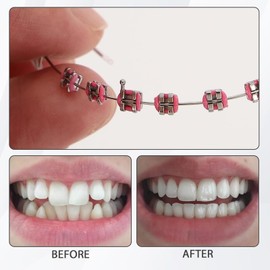 2PCS, Colorful Metal Bracket and Ligature Ties,Temporary Dental Fake Braces,Tooth Decoration with Metal Wires with Hook,Teeth Straightening Kit,Fake Braces,Braces Teeth,Teeth Aligner