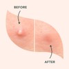 a.l.m. Magical Patch: Hydrocolloid pimple patches. These ultra thin &