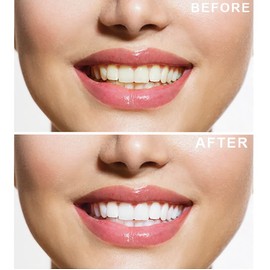 Teeth Whitening Kit & LED Activator - 40 Whitening Sessions - Advanced Whitening Gel Formula, No Sensitivity, 8X3ml Whitening Gels - Ultimate Home Stain Remover Kit