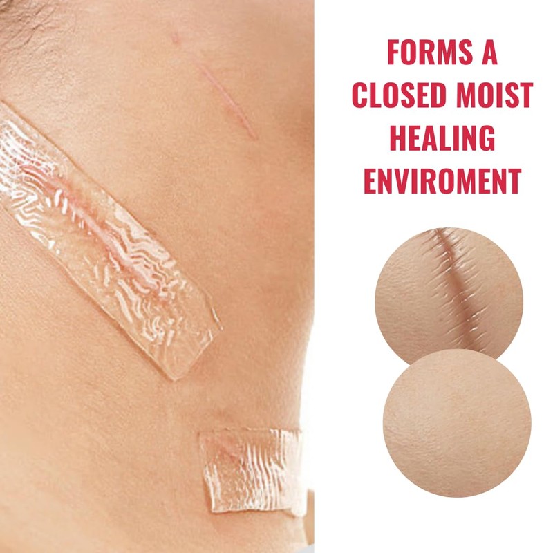 NIEGON Professional Silicone Scar Tape (1.6" x 60") - Scar