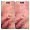 Zitsticka Undercover Ultra Sheer Blemish Patches 36pk