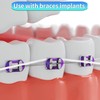 Easy-to-Use Sponge Floss for Cleaning of Implants Bridges with Stiff
