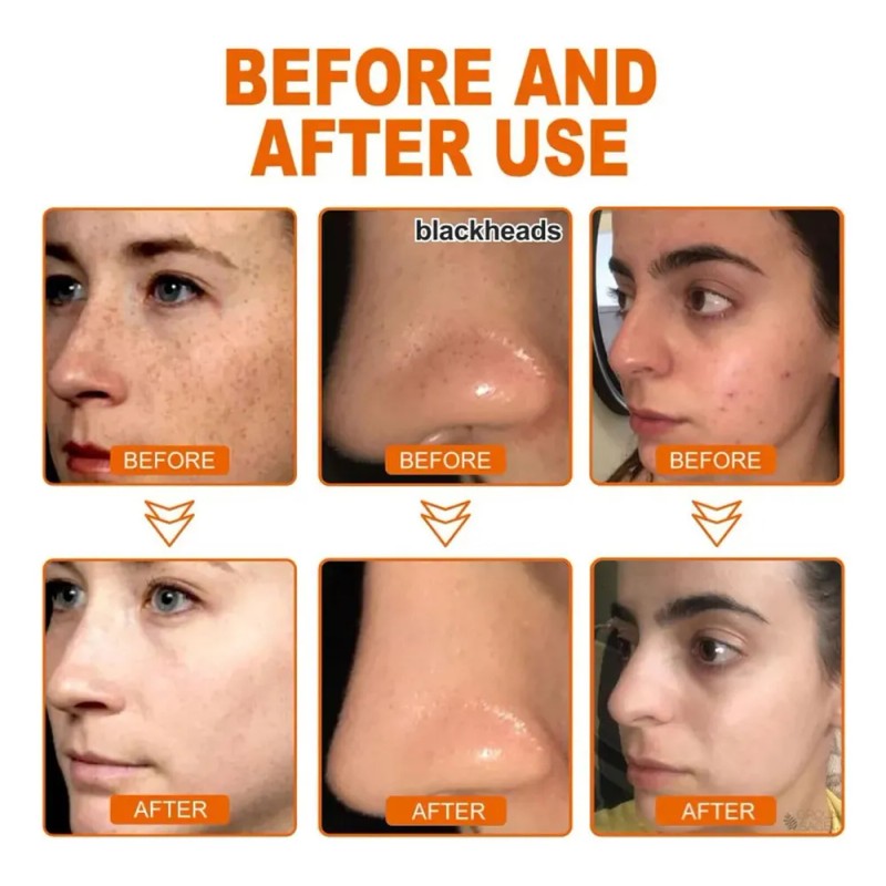 - Onlimerr Mascarilla Facial Peel-off A Base De Hierbas,