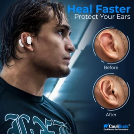 CauliBuds Cauliflower Ear Prevention Kit - Magnetic System for Treating and preventing Cauliflower Ear (Blanco)