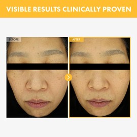 TOSOWOONG 8 Days Spot Cream, Dark Spot Remover for Face, Age Spot, Sun Spot, Freckles, Melasma, Brown Spot Serum, Advanced Formula Corrector Cream with Niacinamide for Women and Men, 50g, 1.76 oz.