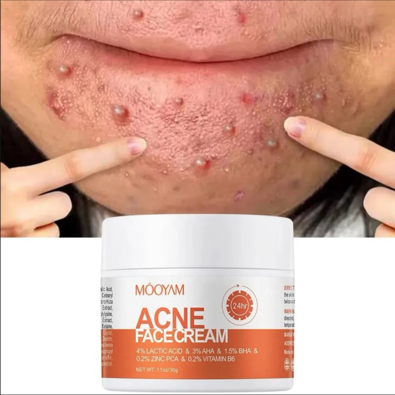 Crema Para El Tratamiento Del Acné Crema Facial Antiacné Pim
