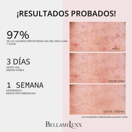 Bellamiluxx Set Tratamiento Para Acné Facial Y Corporal 2pz