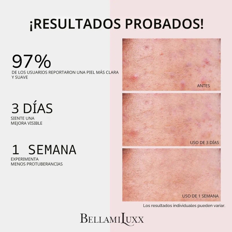 Bellamiluxx Set Tratamiento Para Acné Facial Y Corporal 2pz