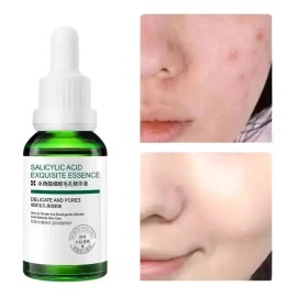 Sérum Facial Con Ácido Salicílico, Reduce Los Poros Y Contro