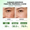 Sérum Facial Hidratante con Tea Tree, Fórmula Ligera y Suave