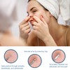 4 Pieces Stainless Steel Acne Needles, Blackhead Remover Tools Pimple