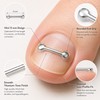 Toenail Care Brace Stickers for Daily Wear – 2PCS Flexible